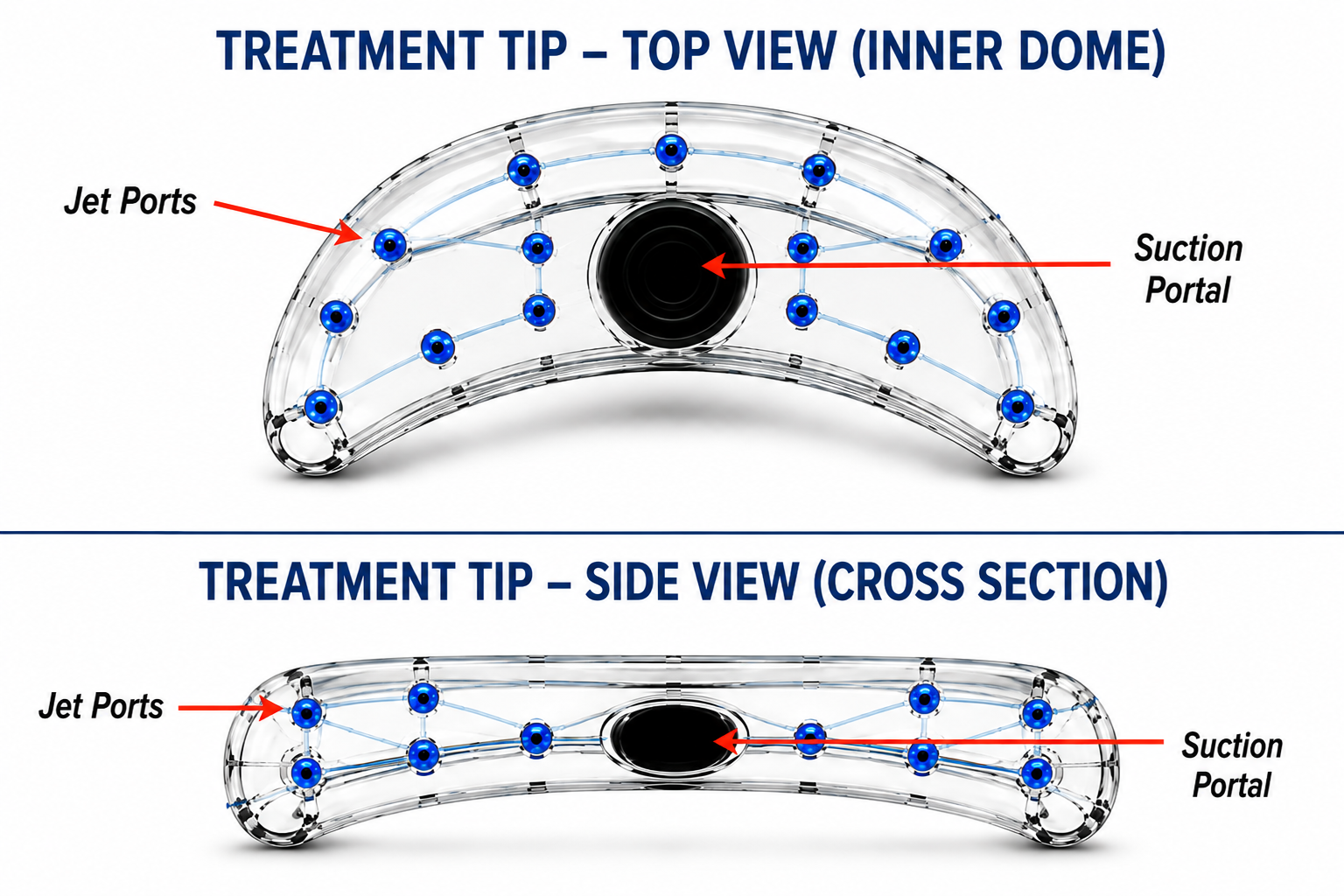 Treatment tip top view and cross-section diagram showing jet ports and suction portal